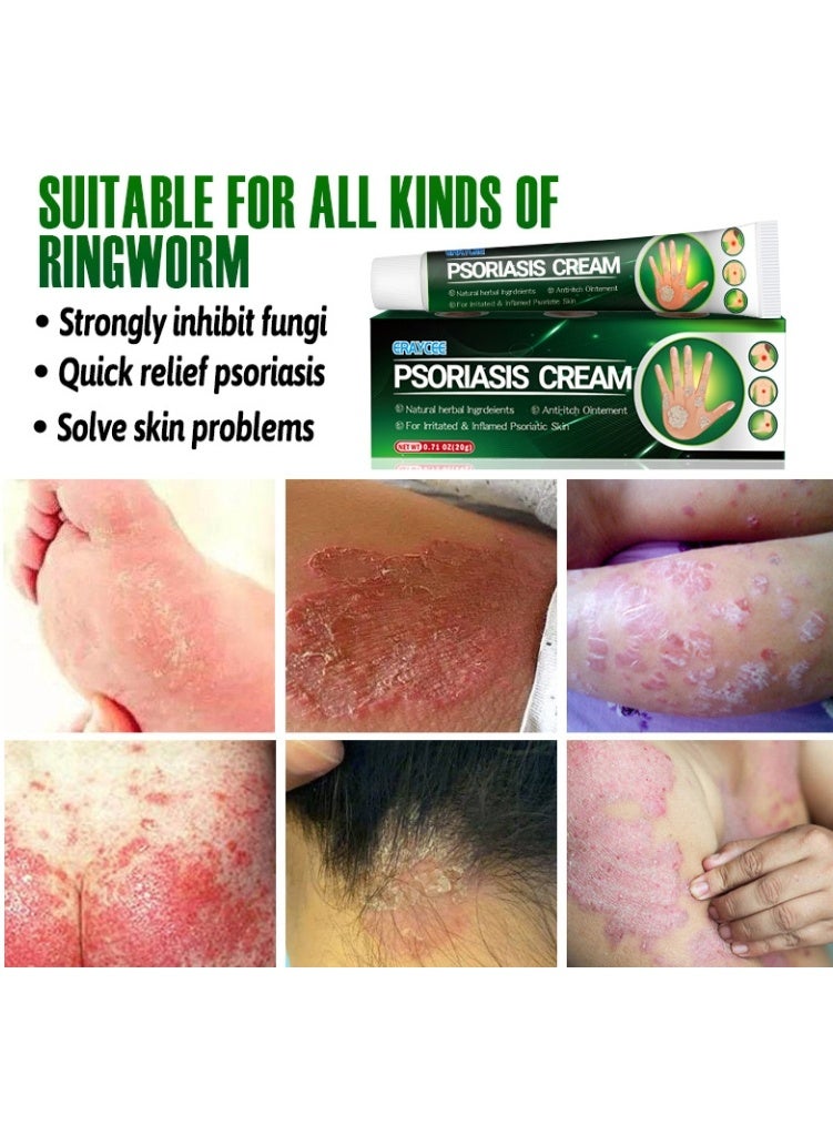 إيرايسي كريم لعلاج الصدفية - مستخلصات نباتية عشبية - عناية بالبشرة المصابة بالصدفية - تخفيف صدفية اليدين والقدمين - تخفيف الحكة - مكونات طبيعية - مرطب ومغذي - 20 غرام - Image 3